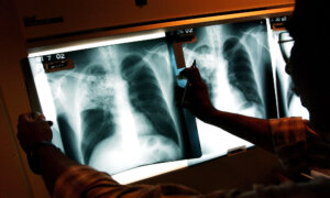 Global Tuberculosis Deaths Declined in 2024: WHO Report