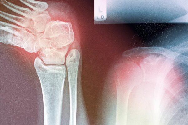 Why Musculoskeletal Diseases Are Rising–And How to Address the Root Causes