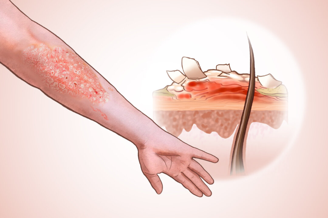 Psoriasis is a chronic autoimmune condition that causes inflamed, scaly skin patches. (Illustration by The Epoch Times, Shutterstock)