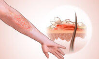 Psoriasis: 2nd Common Autoimmune Condition—5 Lifestyle Approaches May Help