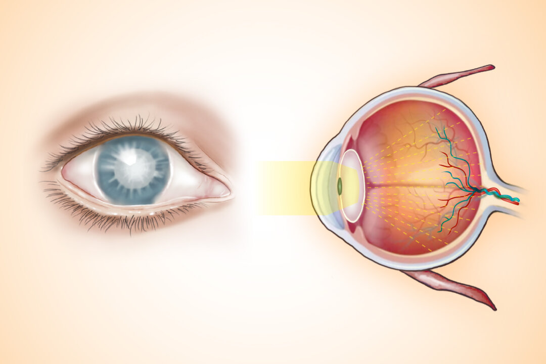 A cloudy lens caused by cataracts scatters light, making vision appear blurry or hazy. (Illustration by The Epoch Times, Shutterstock)