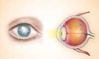 Cataracts: Leading Cause of Blindness–Here Are Its Early Signs