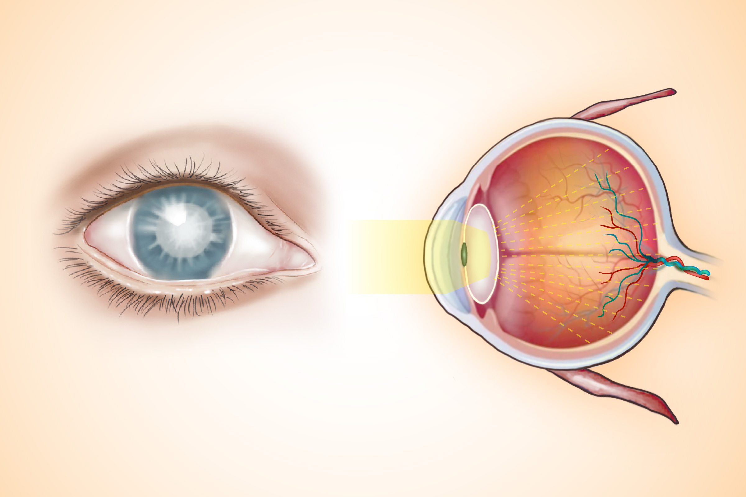 Cataracts: Leading Cause of Blindness–Here Are Its Early Signs