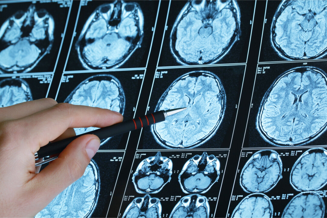 Updated Blood Pressure Guidelines Put Brain Health First