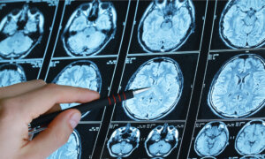 Updated Blood Pressure Guidelines Put Brain Health First