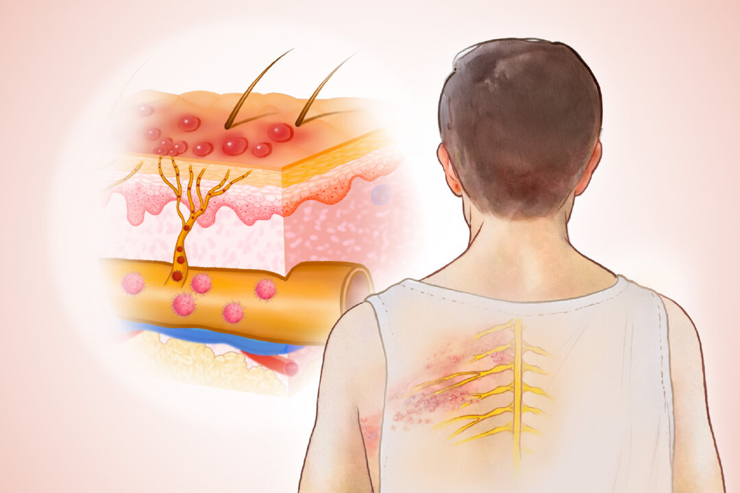 A shingles rash typically appears as painful, blistering skin on one side of the body. (Illustration by The Epoch Times, Shutterstock) 