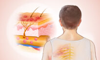 Shingles: Dormant Virus That Emerges After Decades—Here are the Causes