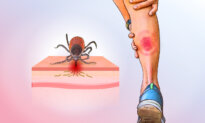 Lyme Disease: A Silent Tick Bite Turns Into a Serious Condition—Here Are the Early Signs