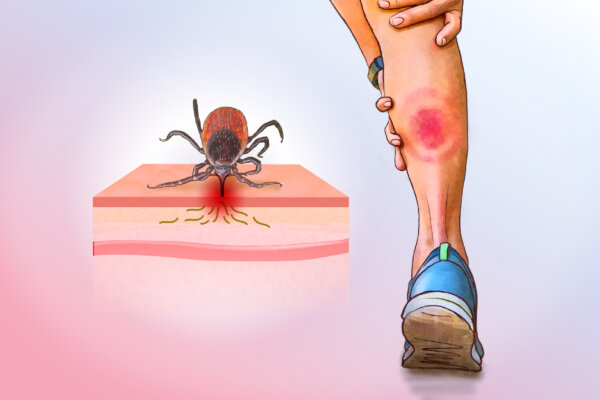 Lyme Disease: A Silent Tick Bite Turns Into a Serious Condition—Here Are the Early Signs