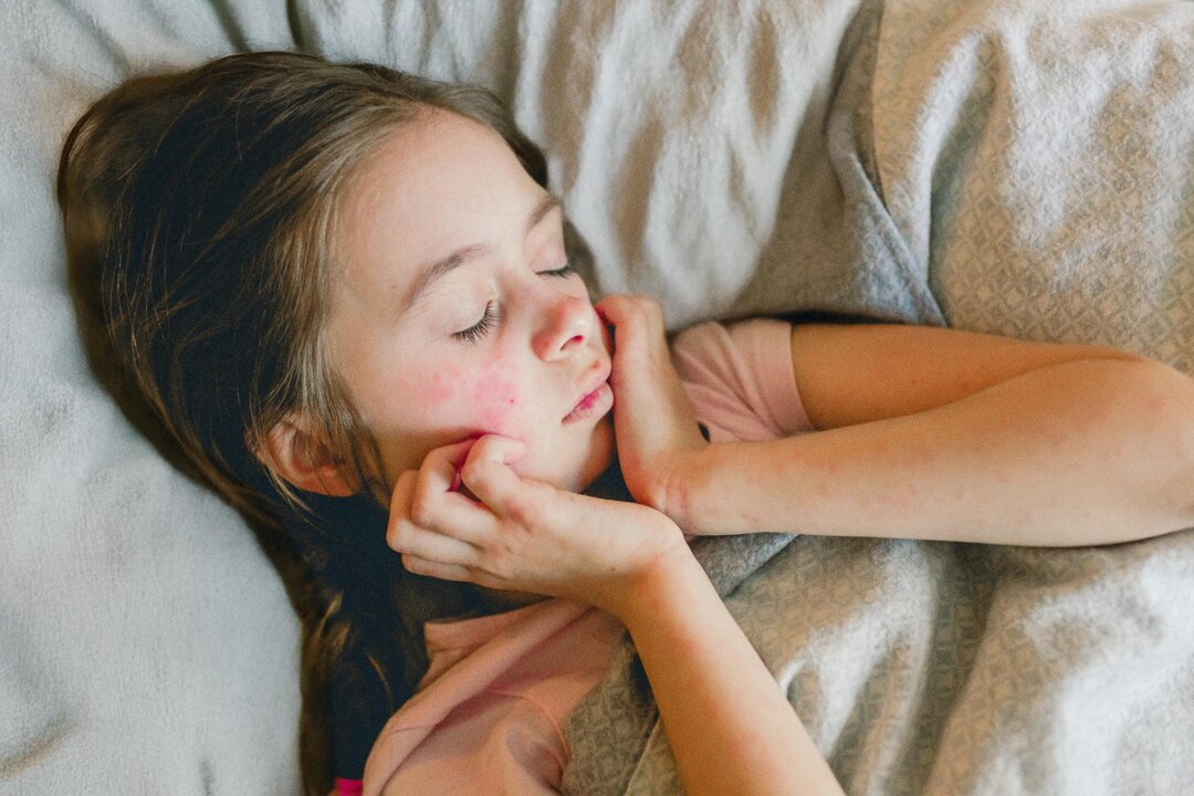 Eczema Is More Than ‘Dry Skin’: 5 Practical Tips You Can Apply
