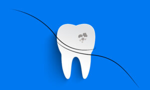 Hair Protein May Be Used for Dental Fillings