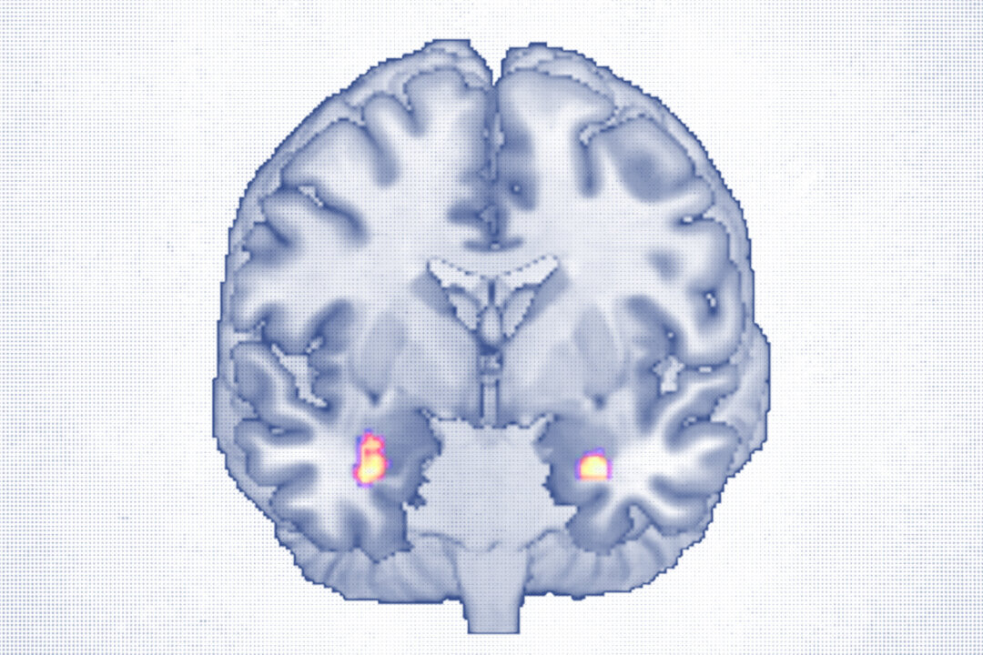 Cognitive Behavioral Therapy Reshapes Brain Structure