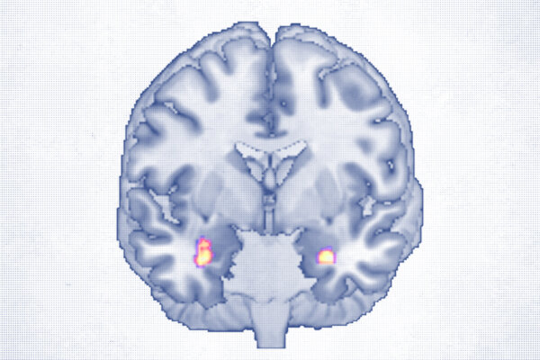 Cognitive Behavioral Therapy Reshapes Brain Structure