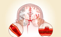Stroke: A Condition That Occurs Every 40 Seconds With Lasting Effects–Watch Out for Signs