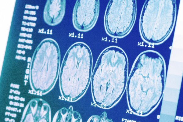 How High Blood Pressure Is Linked to Alzheimer’s Disease