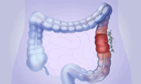 Colon Cancer: How Harmless Polyps Can Turn Dangerous–Here Are the Early Signs