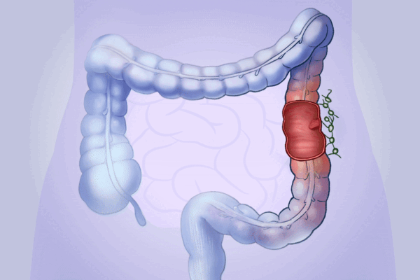 Colon Cancer: How Harmless Polyps Can Turn Dangerous—Here Are the Early Signs