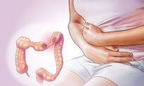 Irritable Bowel Syndrome: Most Common Gut Disorder–Key Symptoms to Watch For