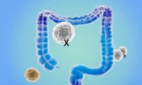 Study Reveals When Colon Cancer Is Considered Cured