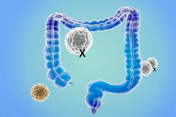 New Criteria for Colon Cancer Revealed