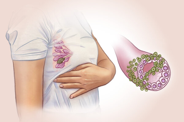 Breast Cancer: 2nd Most Common Cancer in Women—Here Are the Early Signs