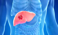 60 Percent of Liver Cancer Can Be Prevented—Here’s How