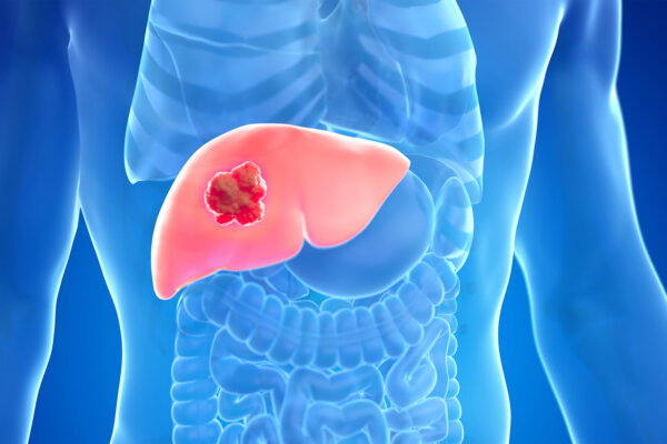 60 Percent of Liver Cancer Can Be Prevented
