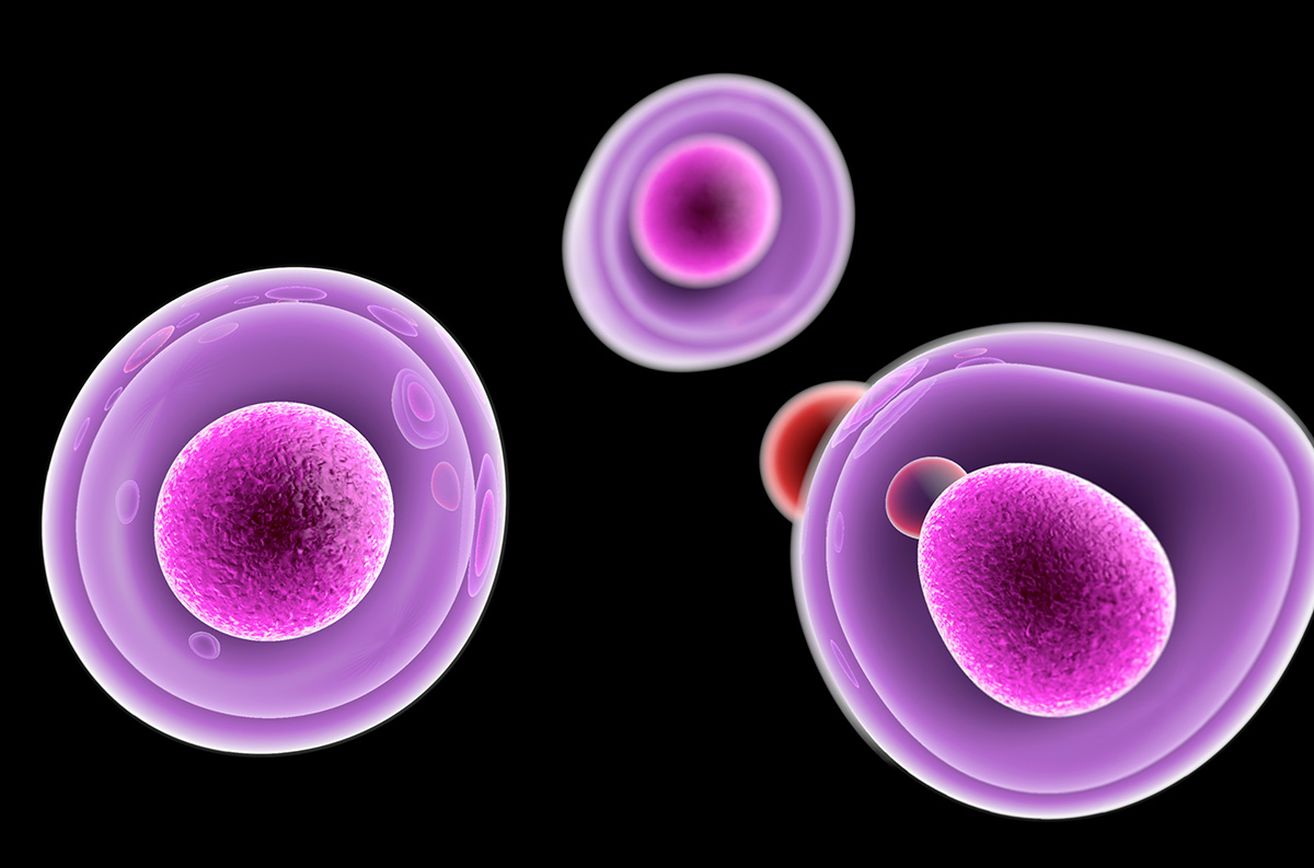 Study Reveals a Rising Uncommon Breast Cancer