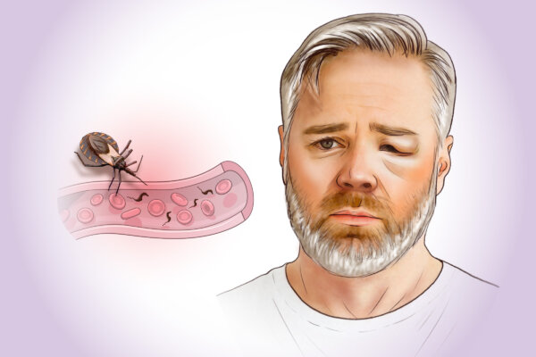 Kissing Bug: What It Does to You and How to Protect Yourself