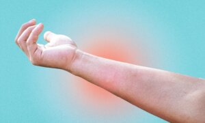 Simple Home Remedies for Burns, Cuts, and Insect Bites