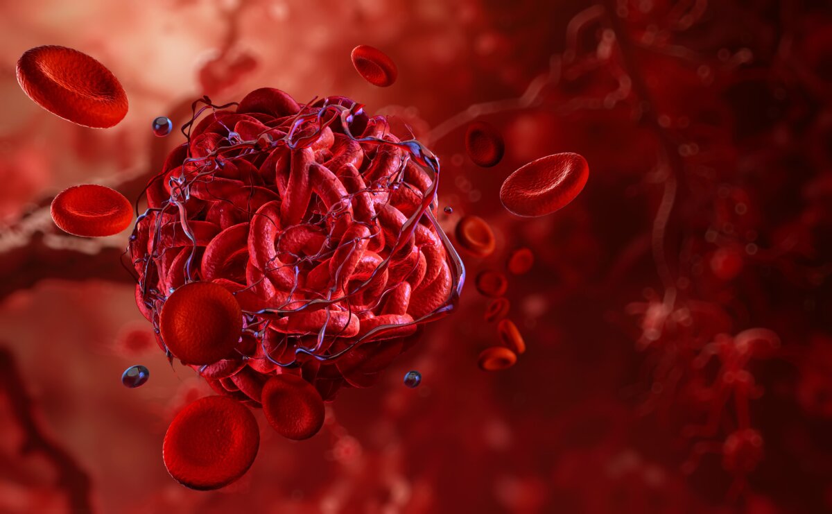 Fibrin Buildup
