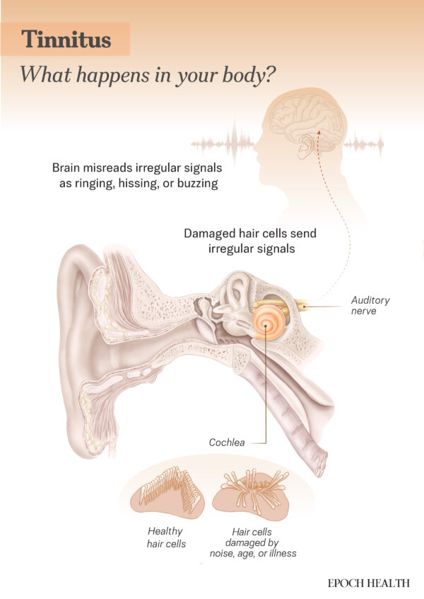 Tinnitus: Ringing or Buzzing Sounds Without an External SourceHere Are the Causes | The Epoch Times Tinnitus: Ringing or Buzzing Sounds Without an External SourceHere Are the Causes | The Epoch Times