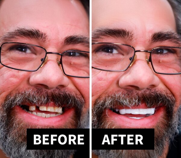 Shiny Smile “Snap-On” Veneers: Get Your Dream Smile Without Seeing A Dentist!