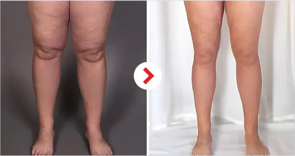 Air-C Leg Massager helps with leg swelling, poor circulation, restless leg syndrome, varicose vein discomfort, post-surgery recovery, and general leg fatigue