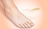 Toenail Fungus: A Stubborn Infection Affecting 1 in 10 People–Signs to Watch For