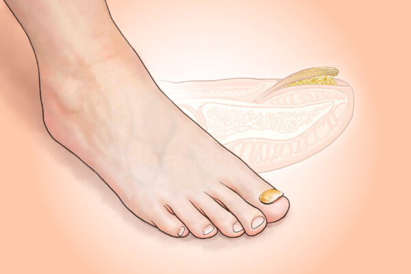  Major Causes of Toenail Fungus