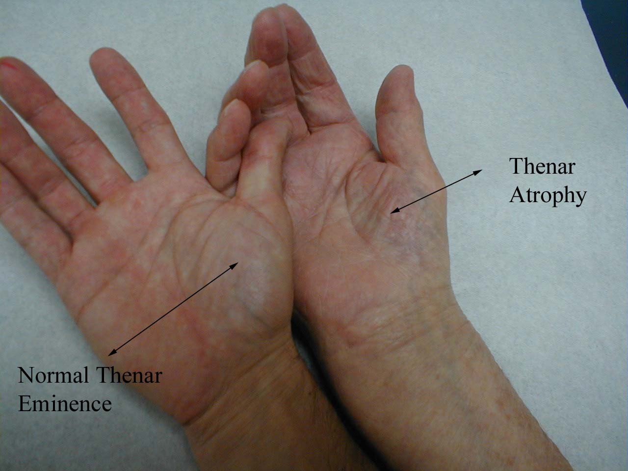 Thenar atrophy. (Photo courtesy of Annie Wu)