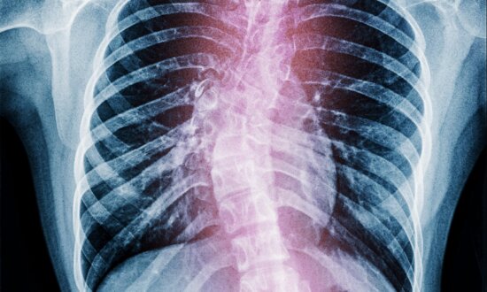 More Than Back Pain: Early Scoliosis Symptoms and Treatments That Can Correct Them
