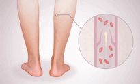 Deep Vein Thrombosis: How Slow Blood Flow Leads to Harmful Clots–Key Symptoms to Watch For