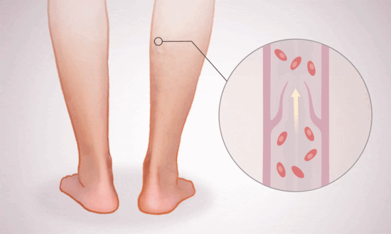 Deep Vein Thrombosis: How Slow Blood Flow Leads to Harmful Clots–Key Symptoms to Watch For