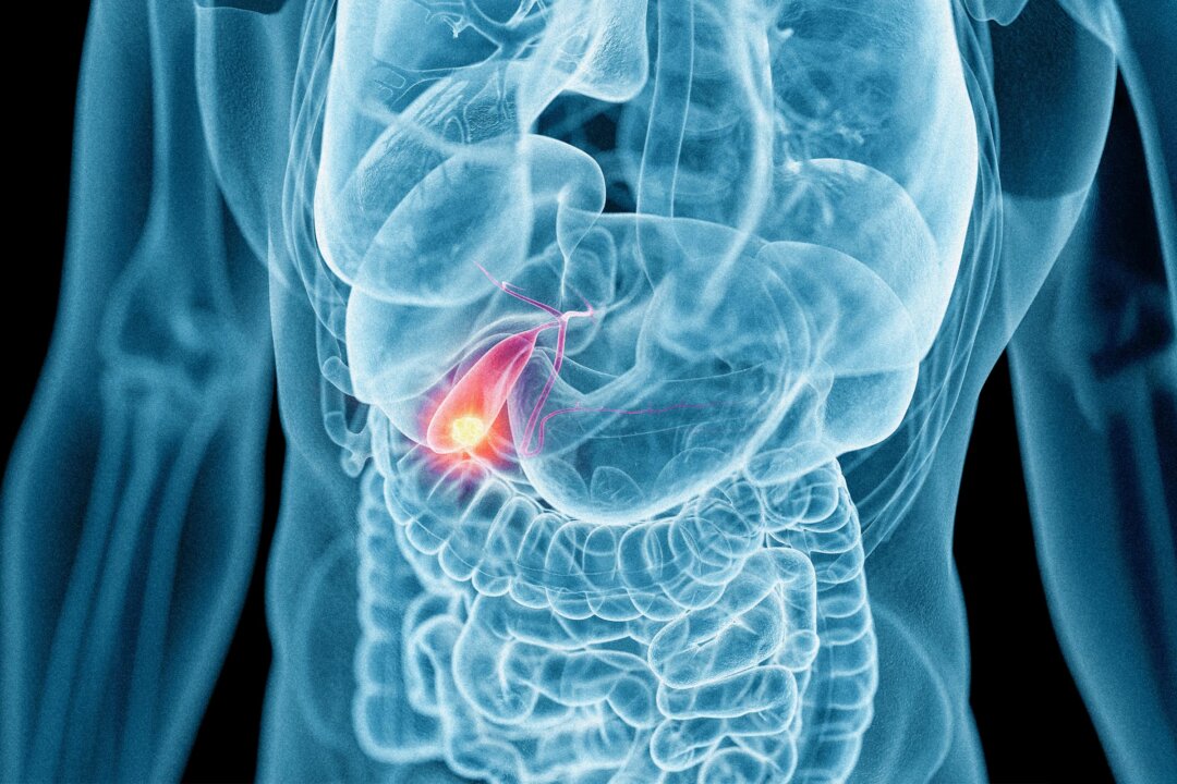 Gallstones cause sudden, severe pain in the upper right abdomen, often with nausea and vomiting.(3dMediSphere/Shutterstock)
