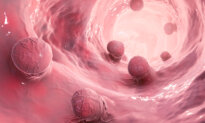 Stiff Colon Tissue Linked to Rising Cancer Cases in Young Adults