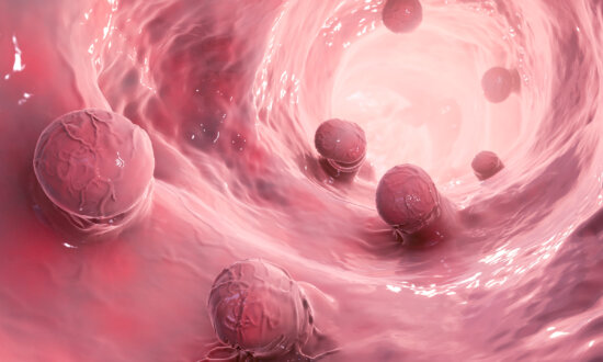 Stiff Colon Tissue Linked to Rising Cancer Cases in Young Adults