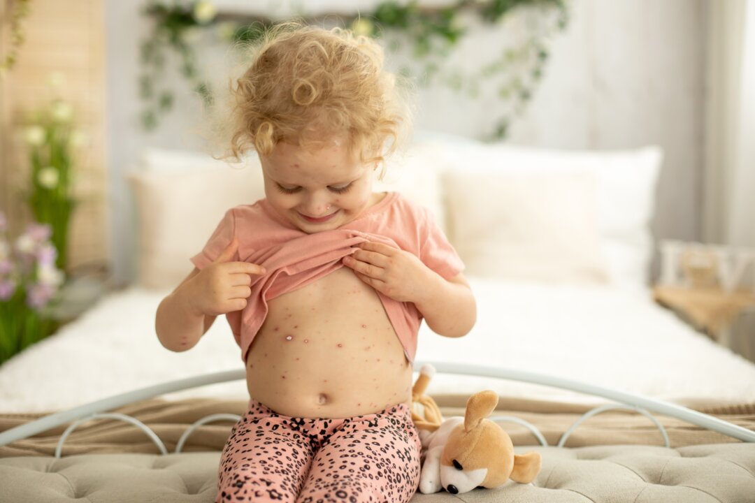 The Chicken Pox Controversy