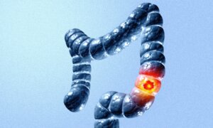 The Cancer Killing More Young Americans Than Any Other–and Why Screening Isn’t Catching It