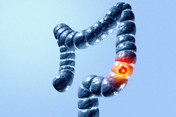 The Cancer Killing More Young Americans Than Any Other–and Why Screening Isn't Catching It