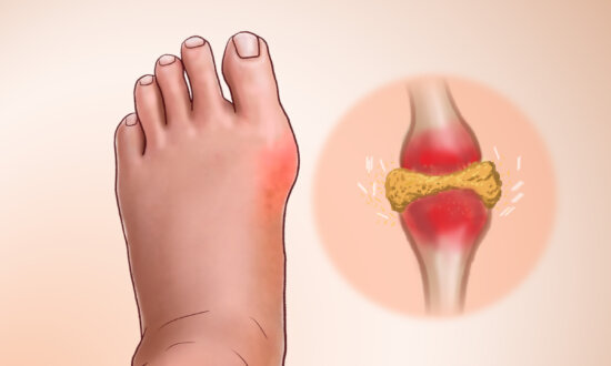 Gout: Crystallized Urate Accumulates in the Joint–6 Natural Approaches to Relieve It