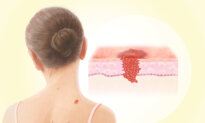 Melanoma: The Aggressive Skin Cancer That Can Spread Quickly–Here Are the Warning Signs