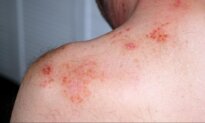 When Stress Shows on Your Skin: From Sudden Hair Loss to Chronic Inflammation