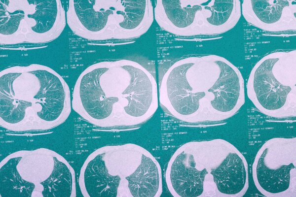 This Aggressive Lung Cancer Often Detected Too Late
